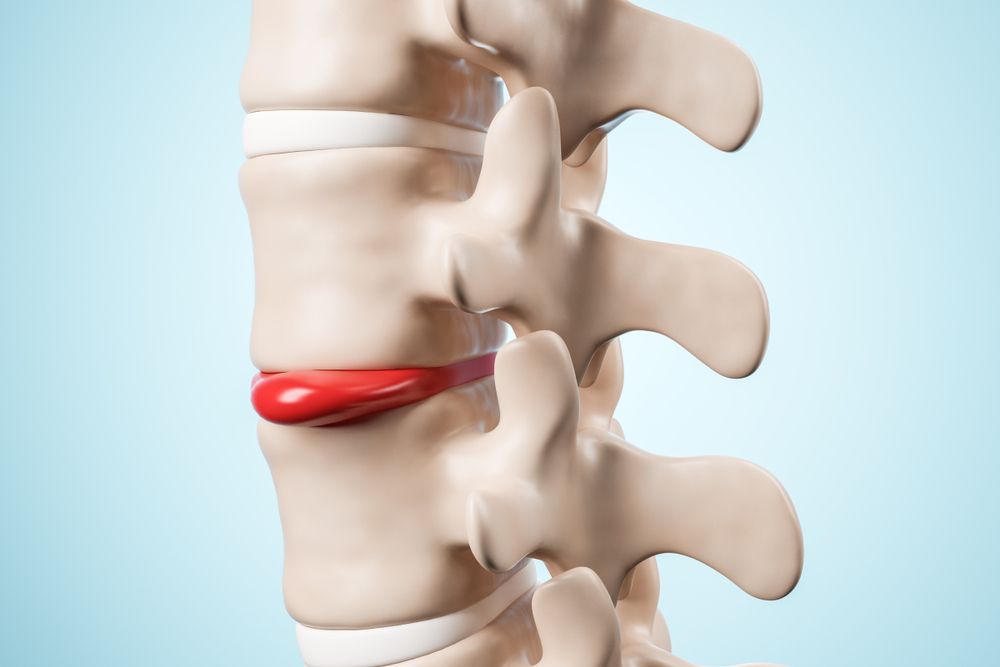 What is a Herniated Disc?